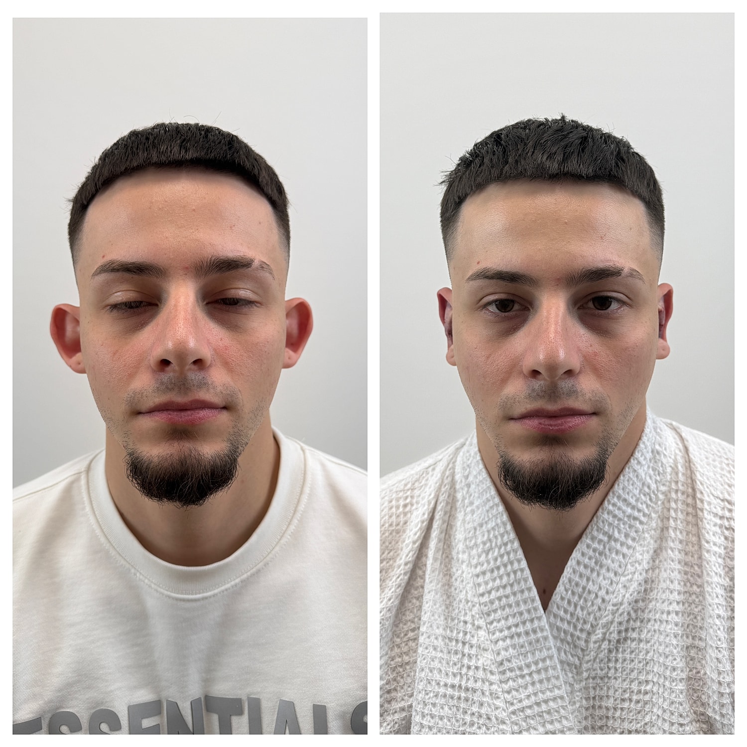 Before and after minimally invasive otoplasty transformation image.