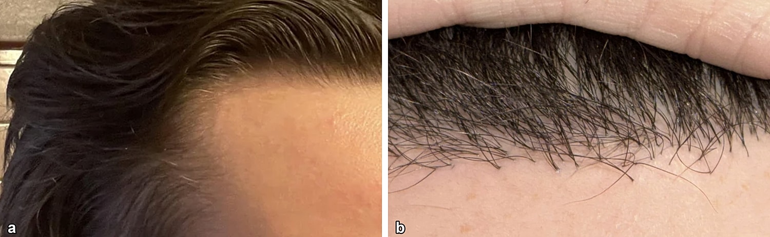 Natural hairline compared to pluggy hairline
