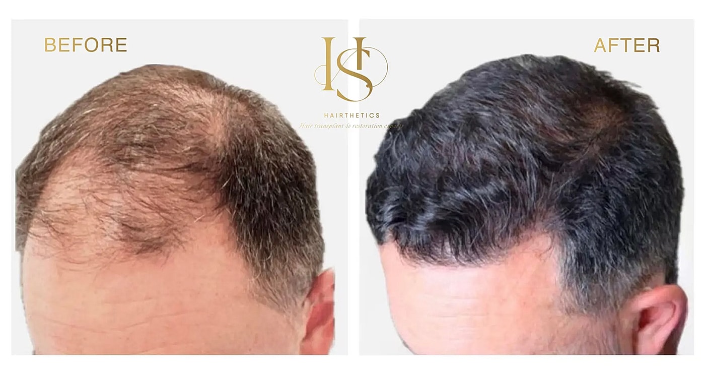 Hair restoration before and after comparison photo.