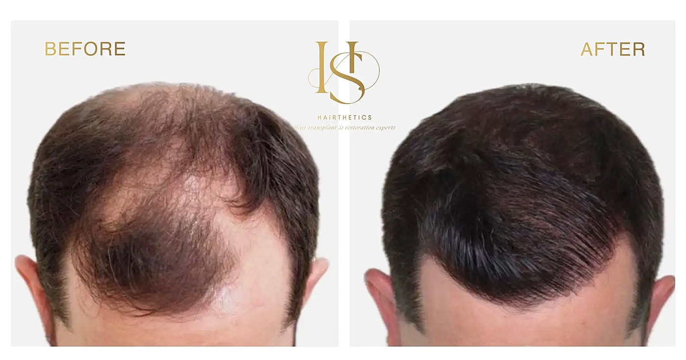 Hair restoration before and after transformation.