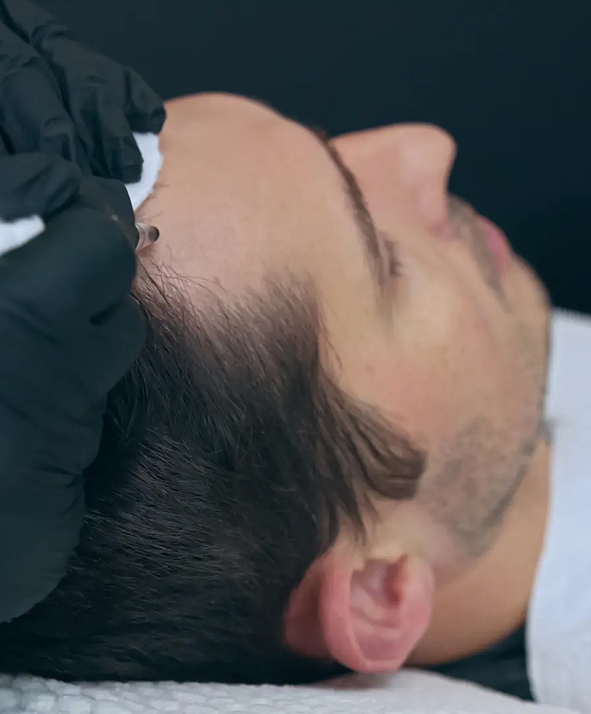Scalp treatment with a tattooing technique.