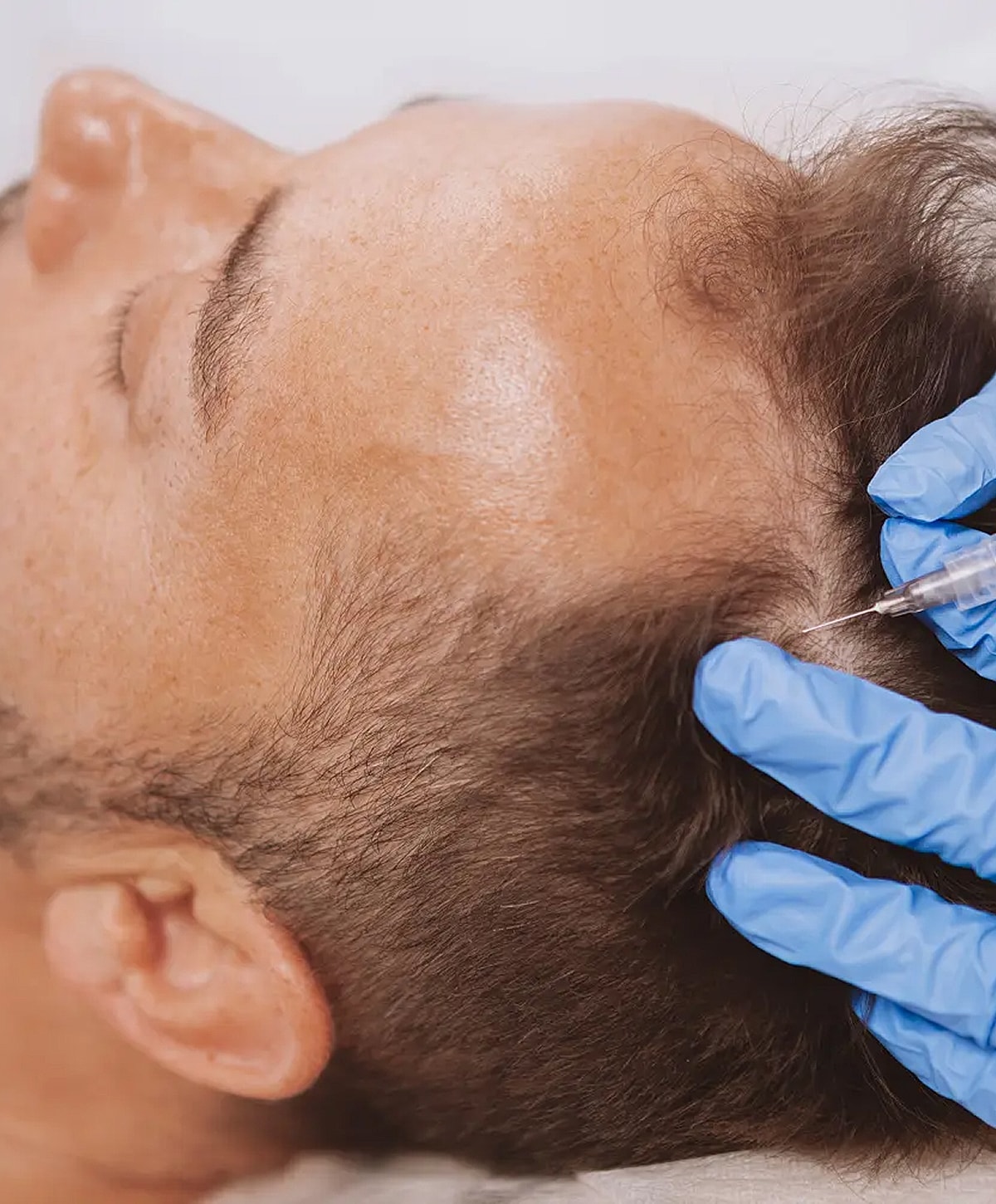 Scalp treatment with injectable procedure underway.