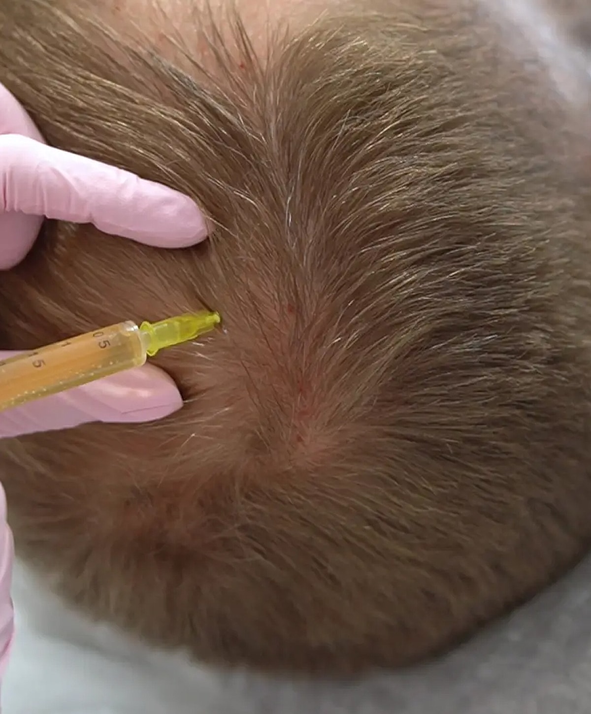Scalp injection for hair restoration treatment.