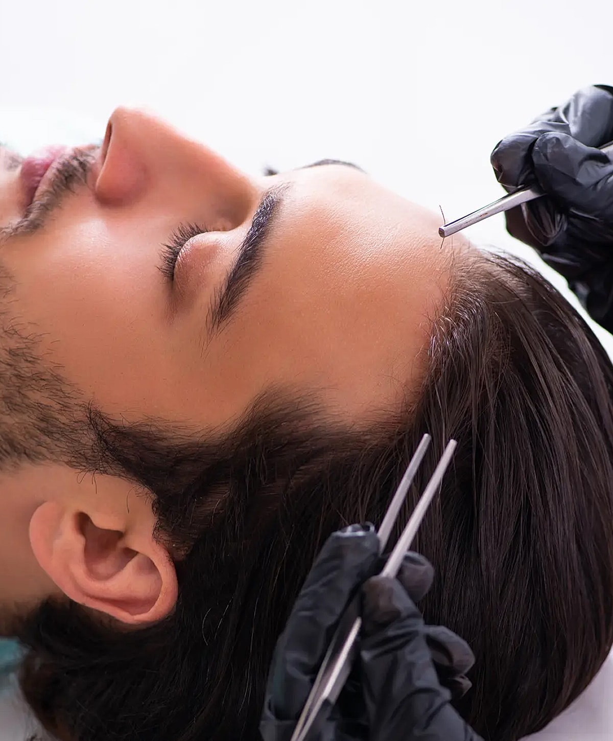 Hair restoration procedure on a male client.