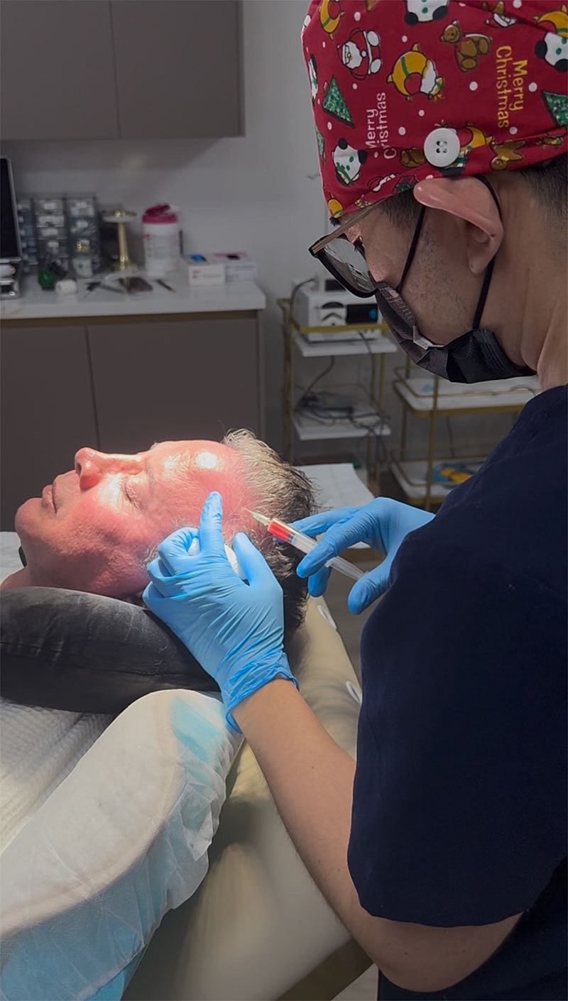 Man receiving Hallandale PRP hair restoration.