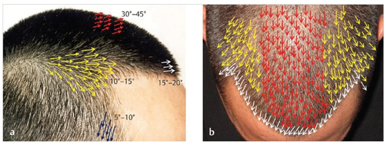 Hair transplant angles and hair direction techniques illustration.