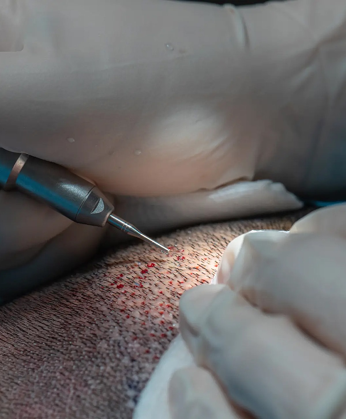 Scalp micropigmentation procedure in progress.