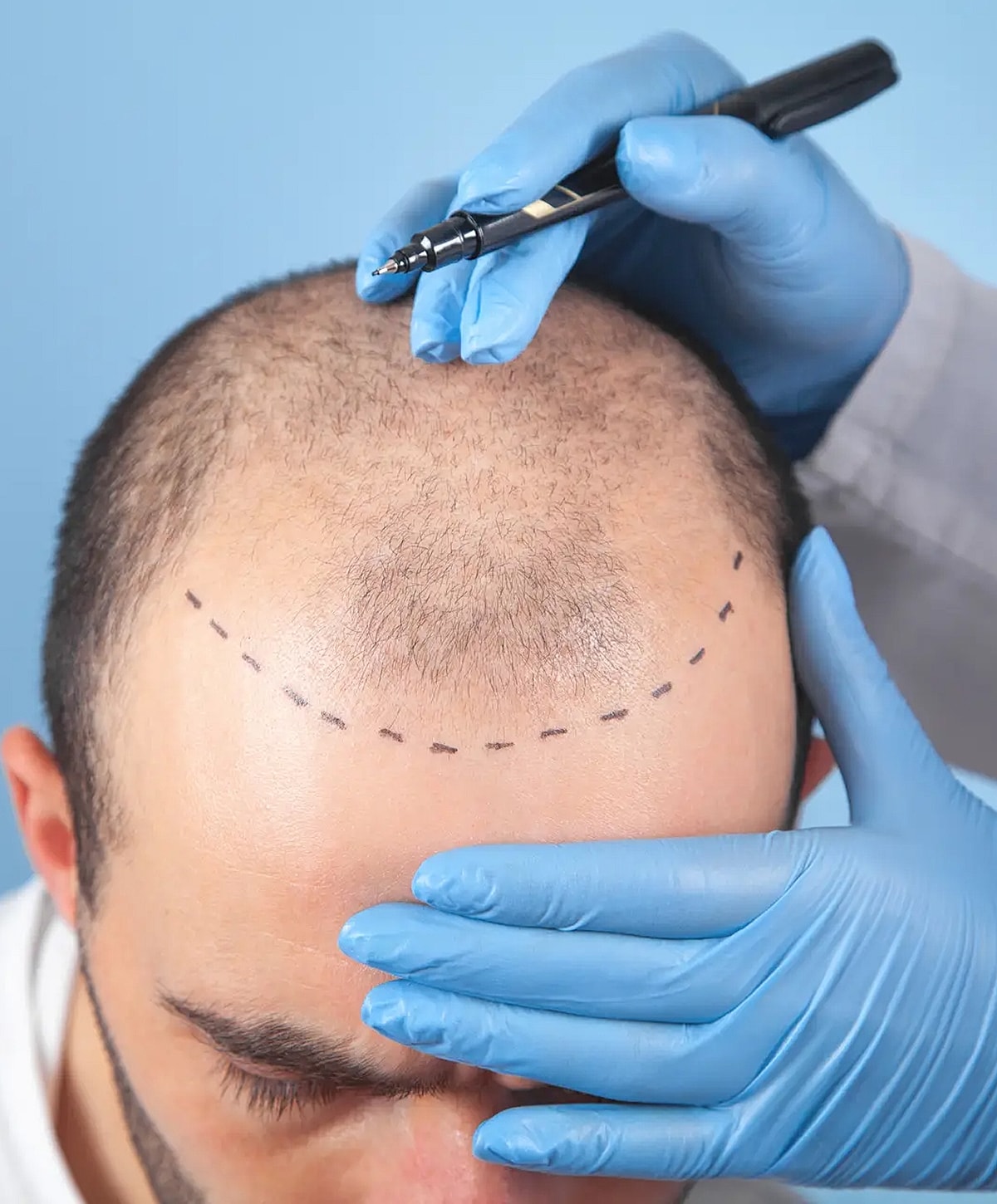 Hair transplant consultation with marked hairline.