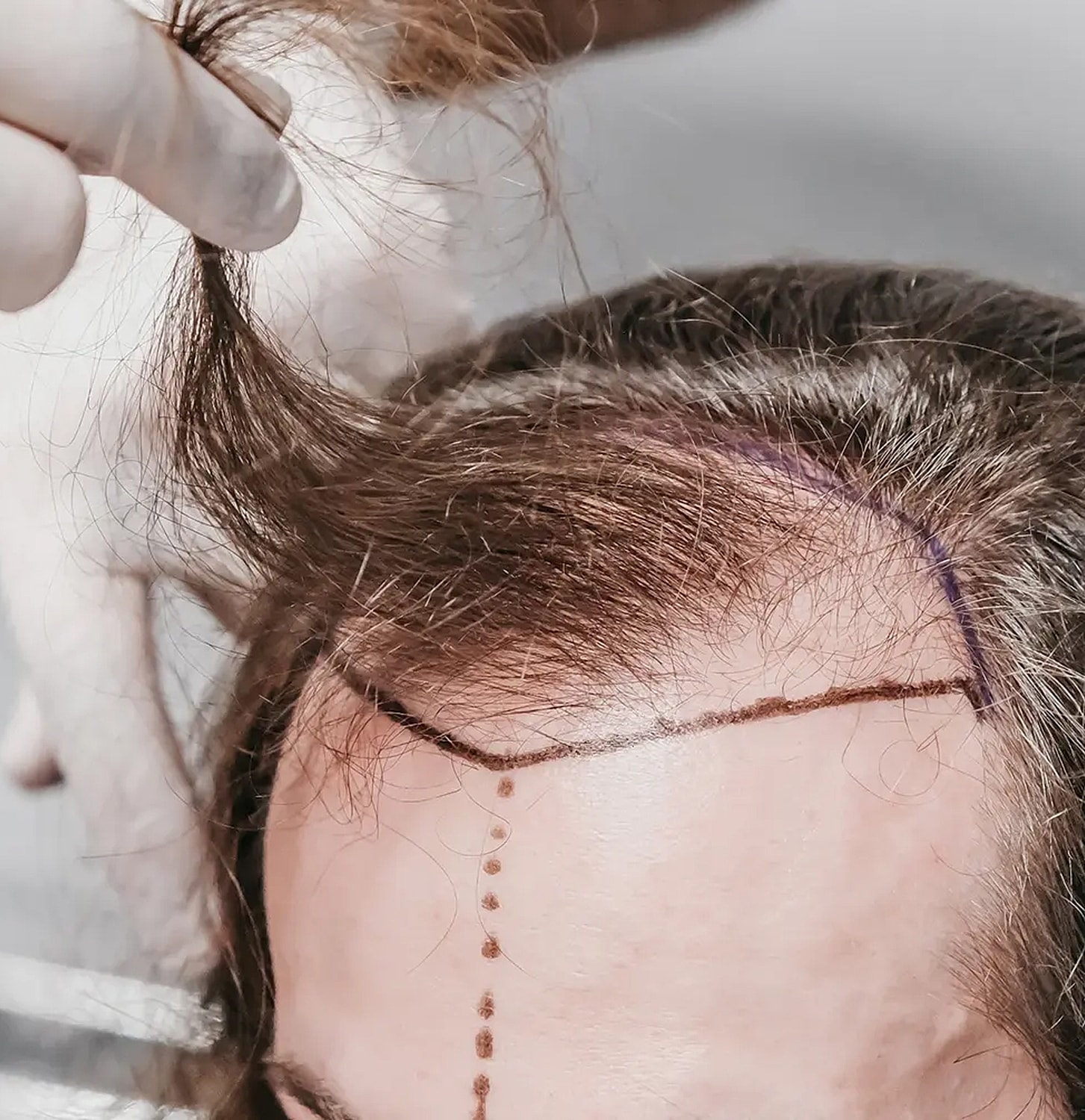 Hair transplant procedure with marked hairline.
