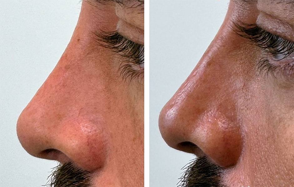 Liquid Rhinoplasty Before & After