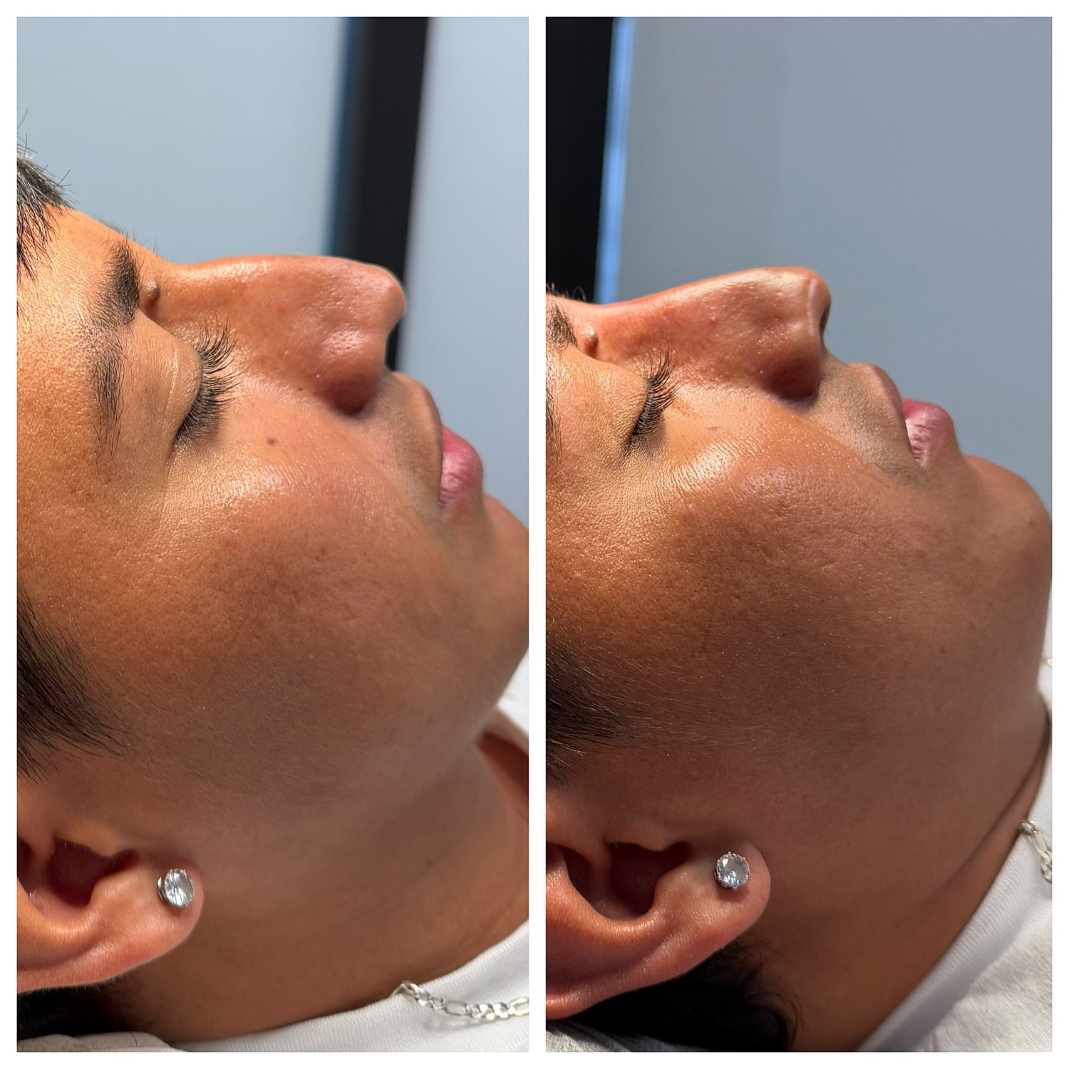 Liquid Rhinoplasty Before & After