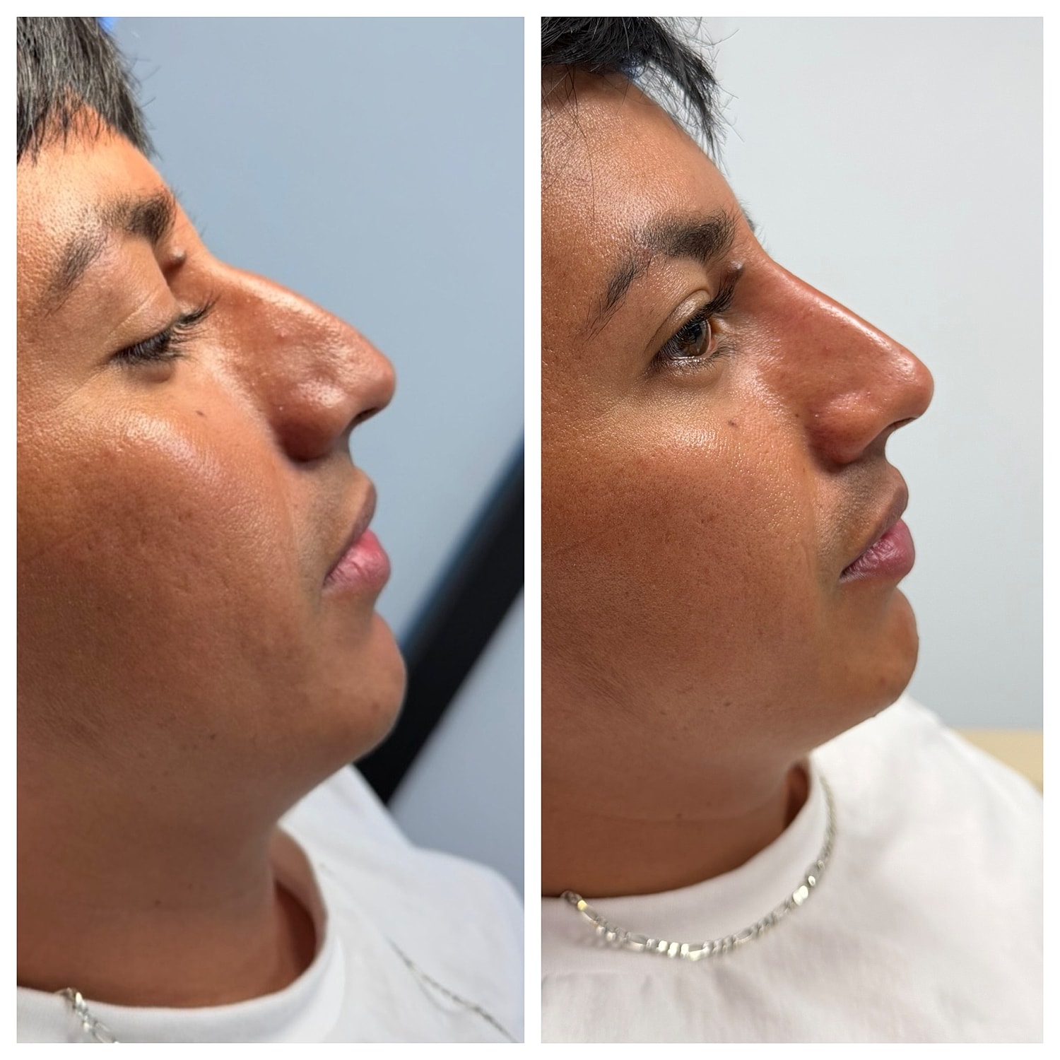 Liquid Rhinoplasty Before & After