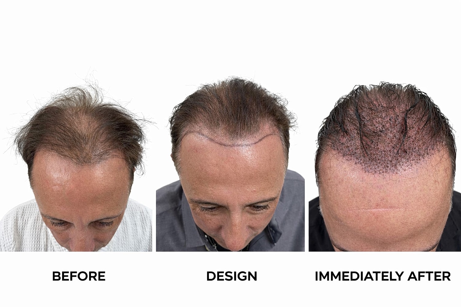 Slim FUE Hair Transplant Before & After