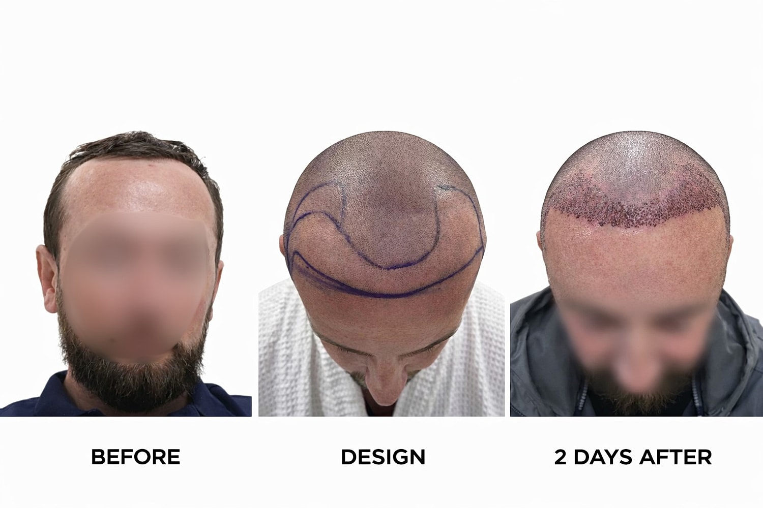 Slim FUE Hair Transplant Before & After