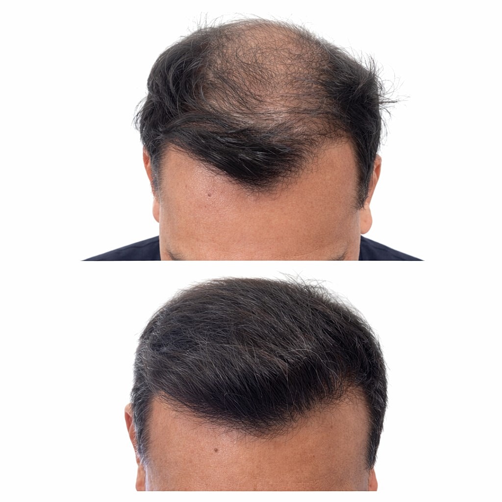 Slim FUE Hair Transplant Before & After
