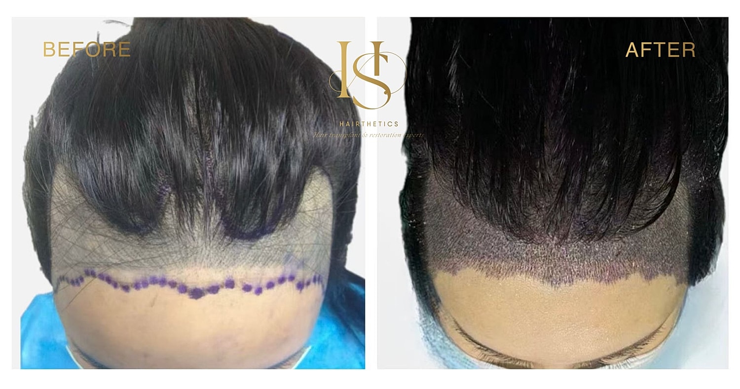 Hair restoration before and after transformation.