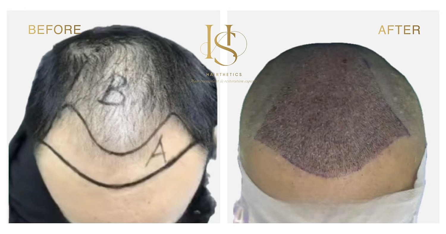 Hair restoration before and after treatment comparison.