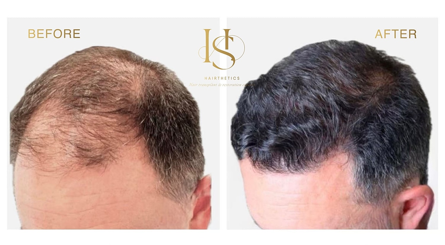 Before and after hair restoration comparison image.