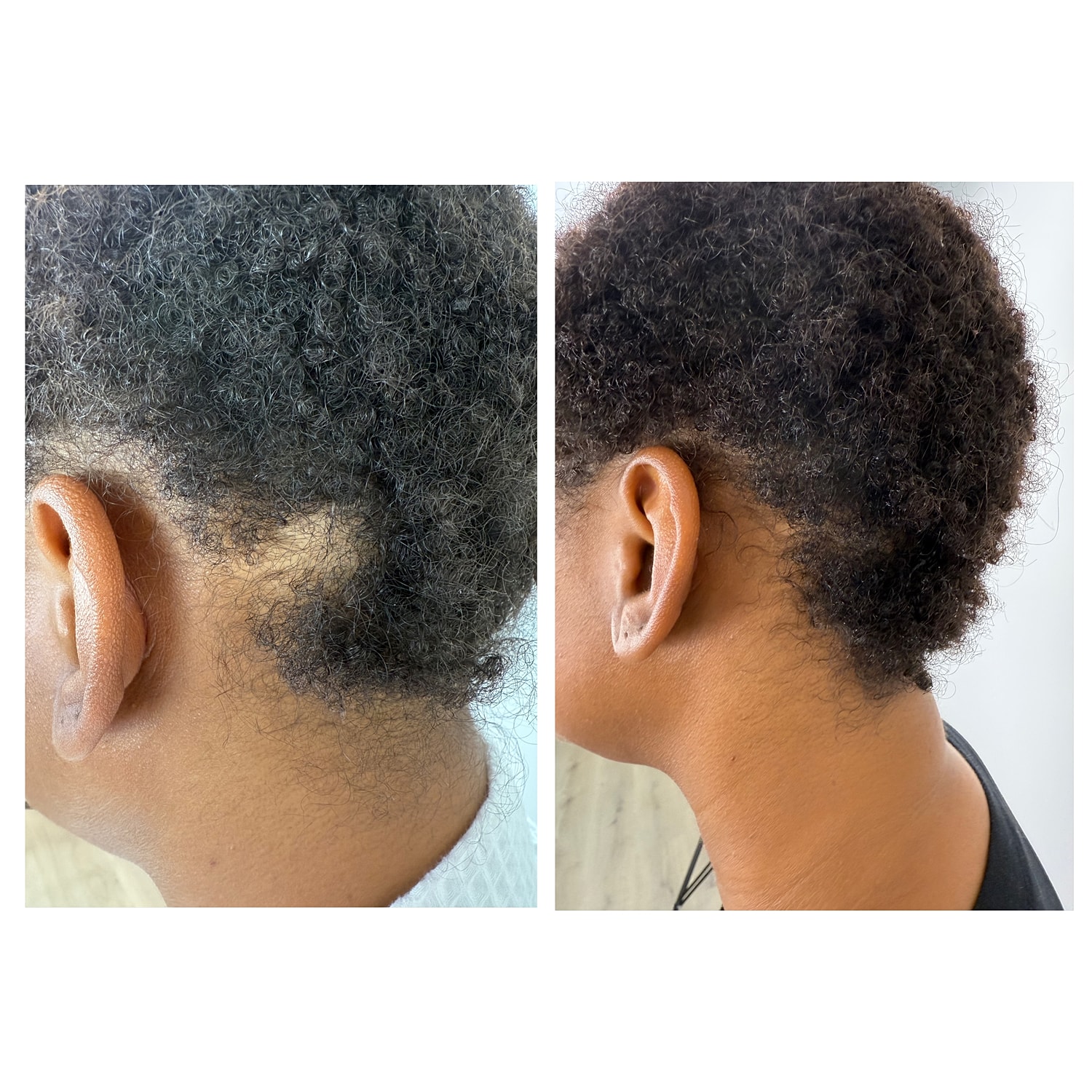 Exosomes For Hair Restoration Before & After