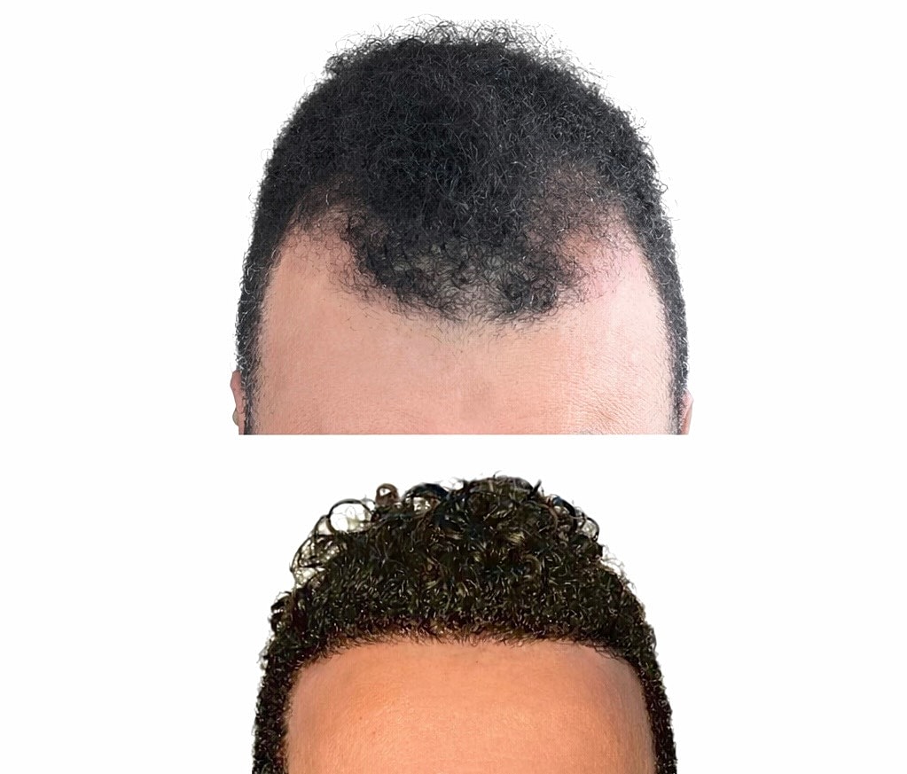 Male Hair Transplant Before & After