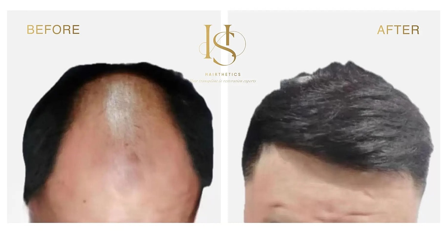 Hair transplant transformation before and after.
