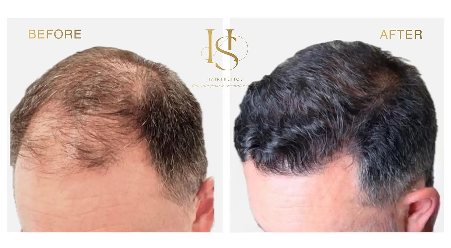 Hair restoration before and after comparison image.