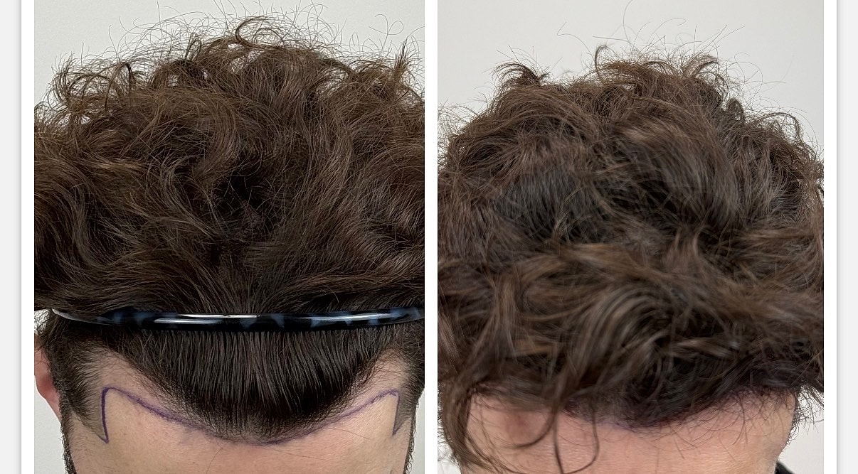 Non-Shave Hair Transplant Before & After