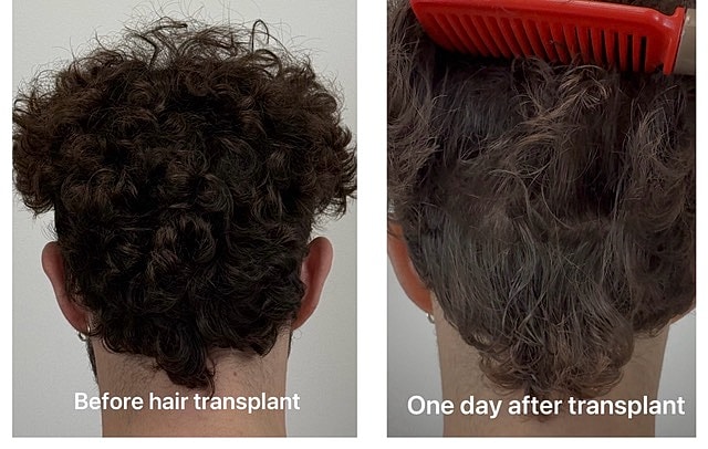 Non-Shave Hair Transplant Before & After