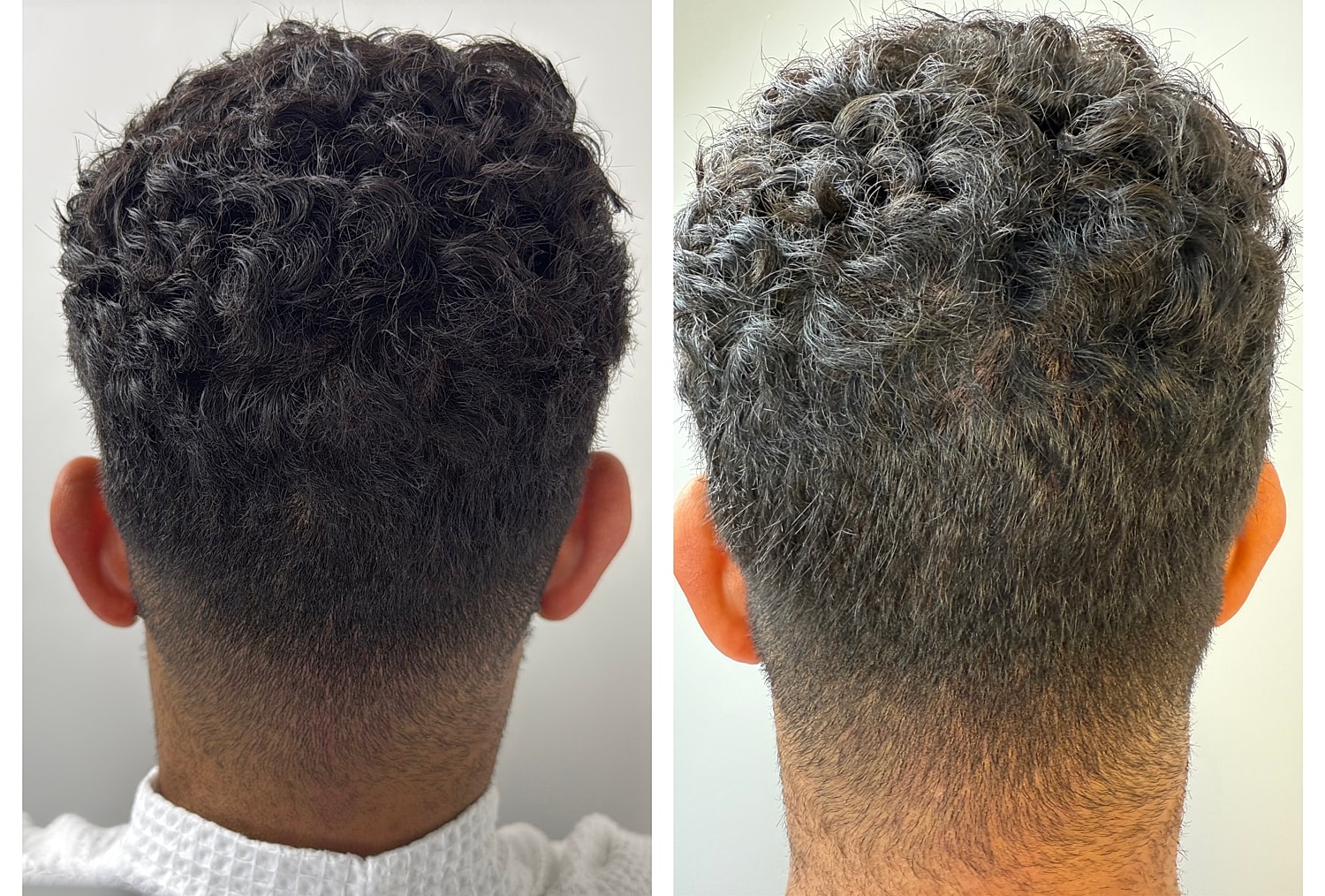 Non-Shave Hair Transplant Before & After