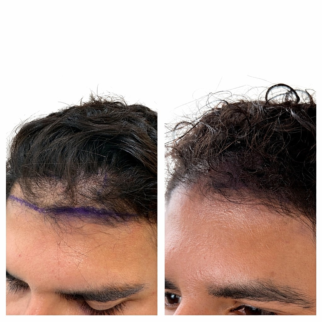 Non-Shave Hair Transplant Before & After