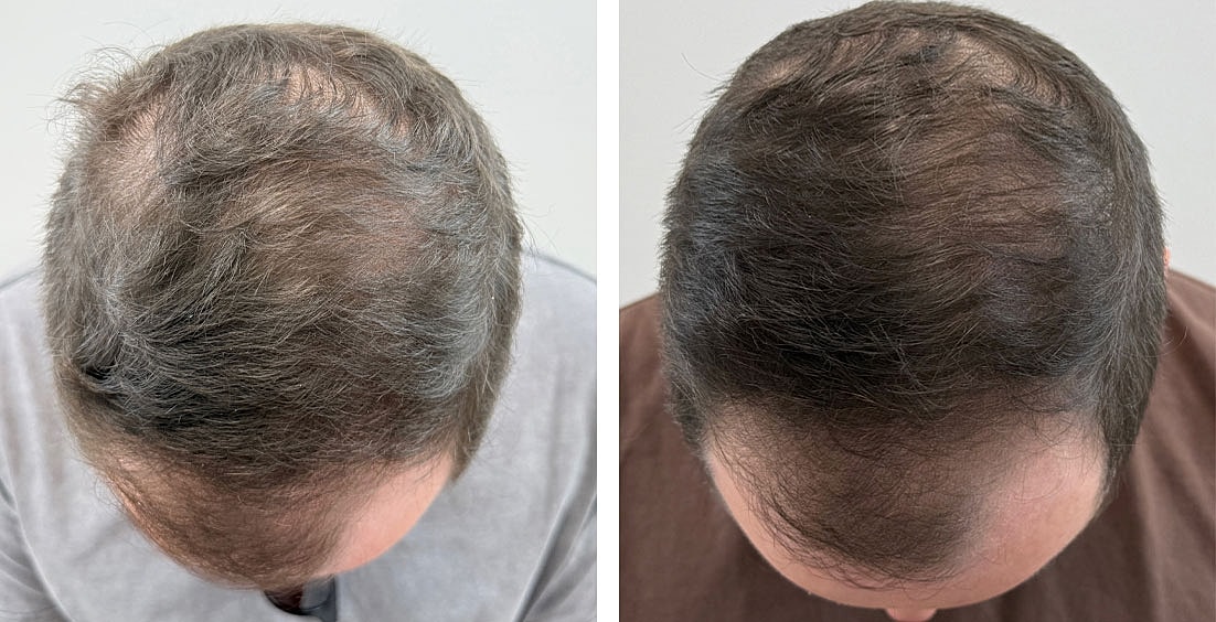 Fractional Laser Therapy Before & After