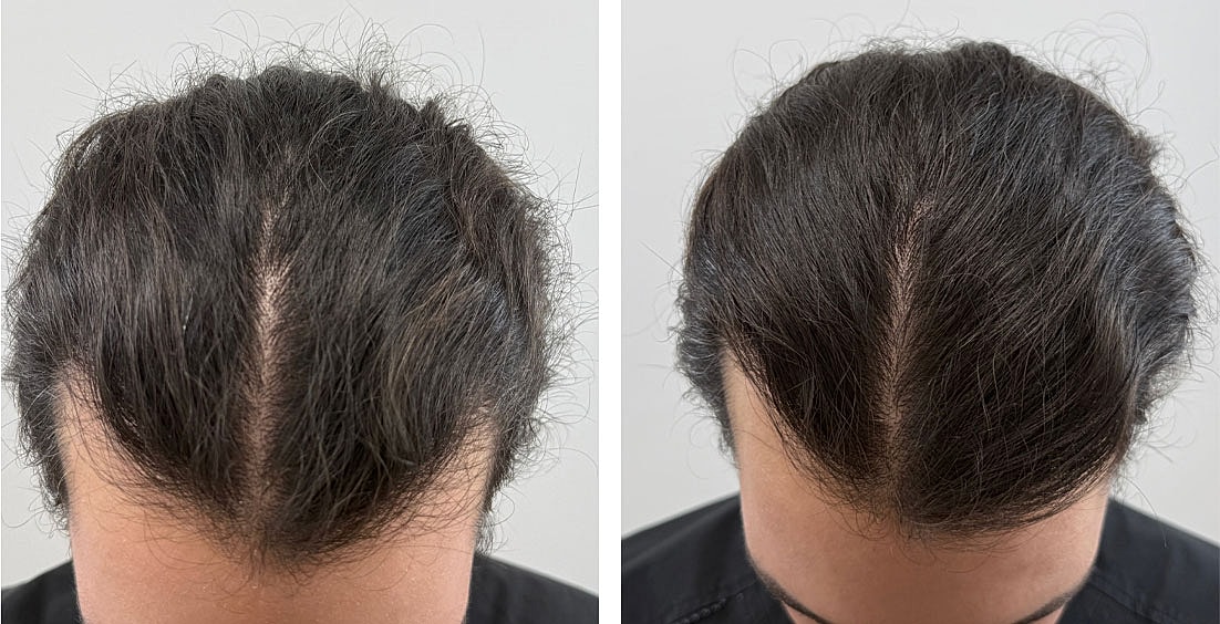 Fractional Laser Therapy Before & After