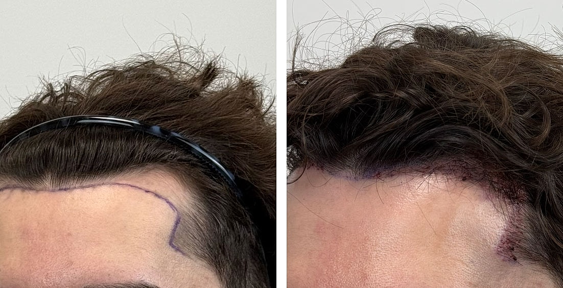 No Shave FUE Hair Transplant Before & After