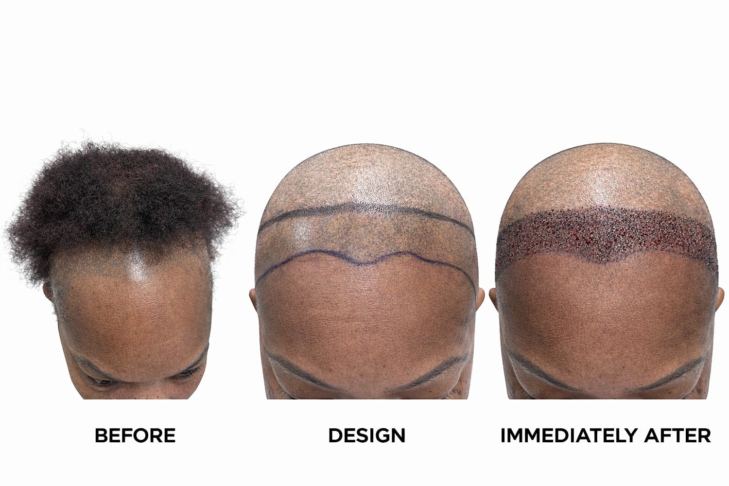 Female Hair Transplant Before & After