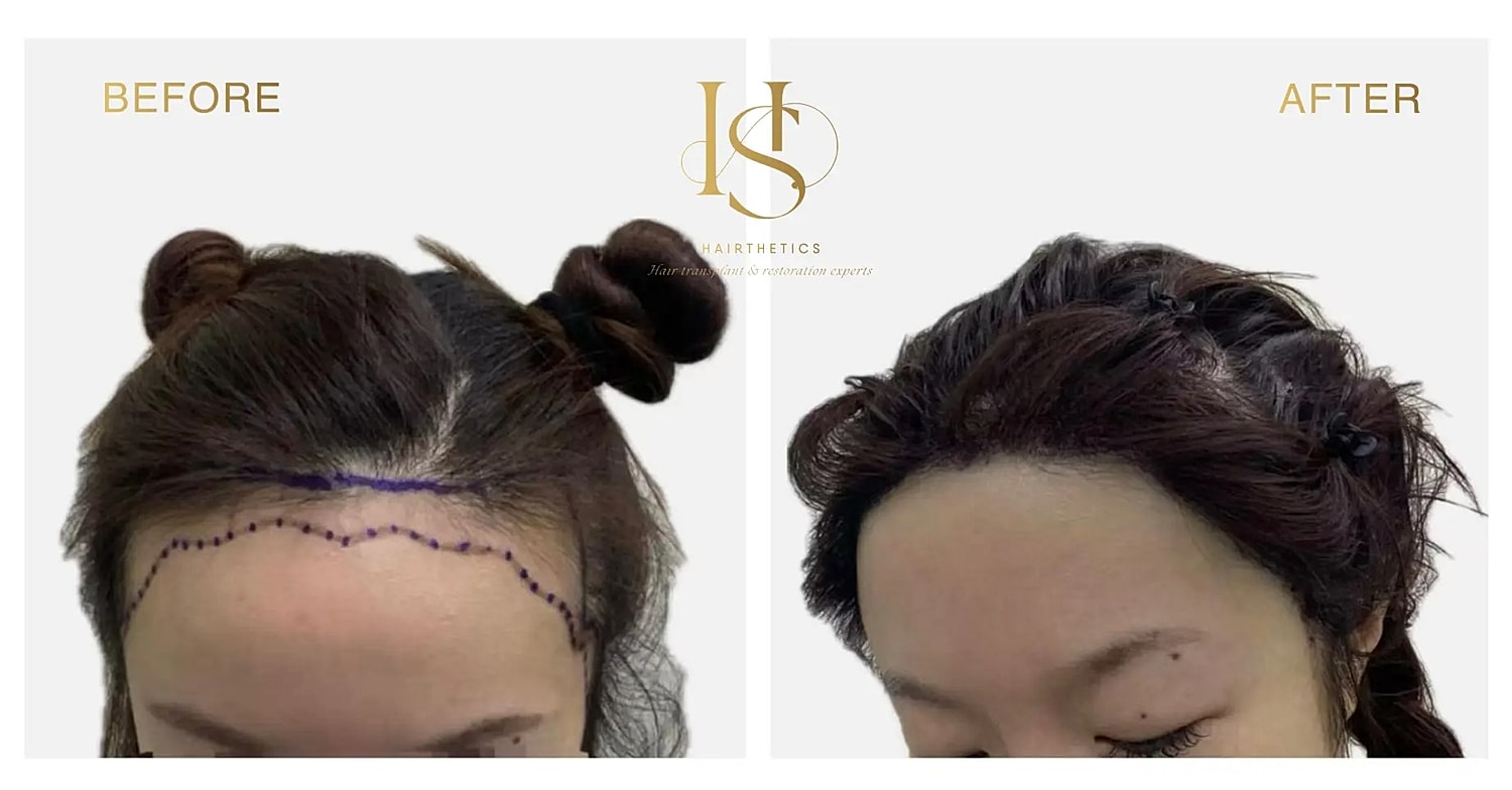 Hair restoration before and after comparison image.