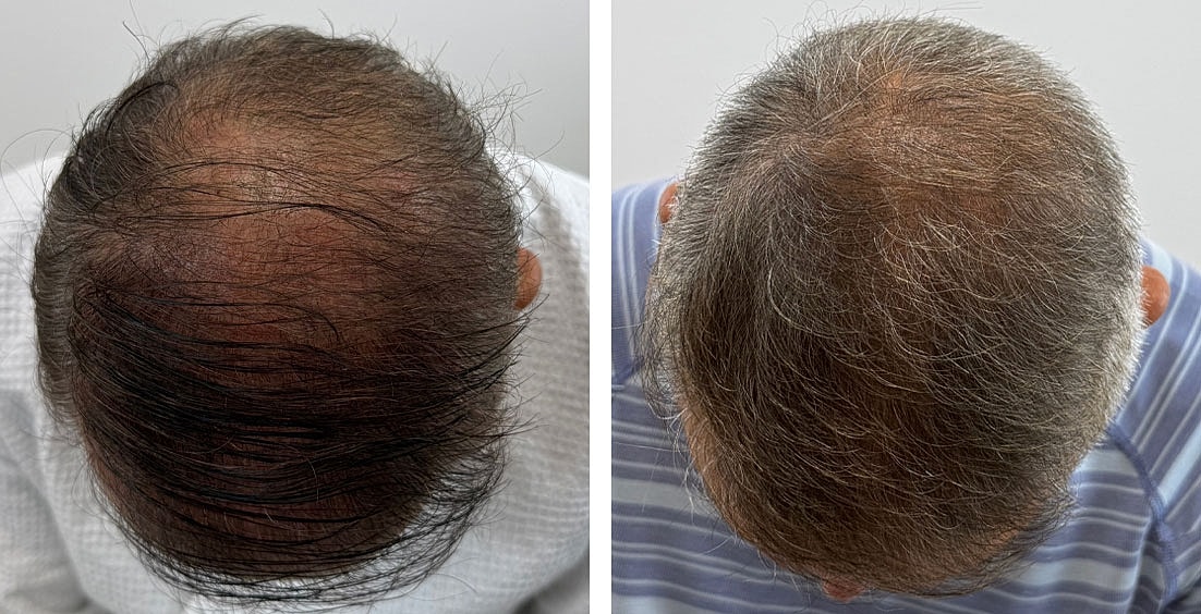 PRP Hair Restoration Before & After
