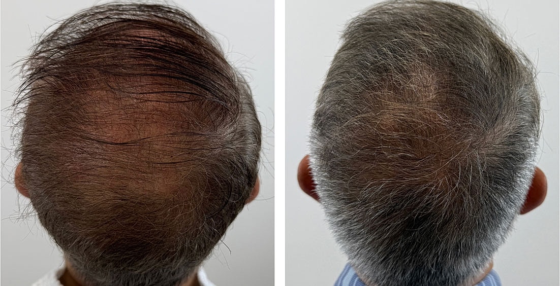 PRP Hair Restoration Before & After