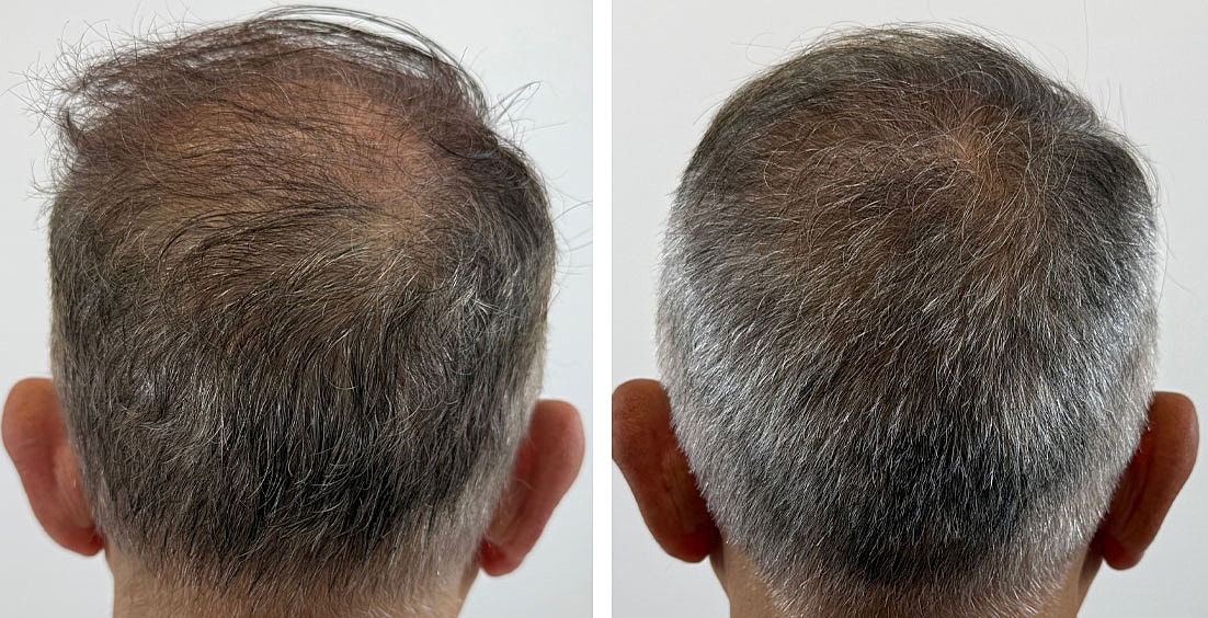 PRP Hair Restoration Before & After