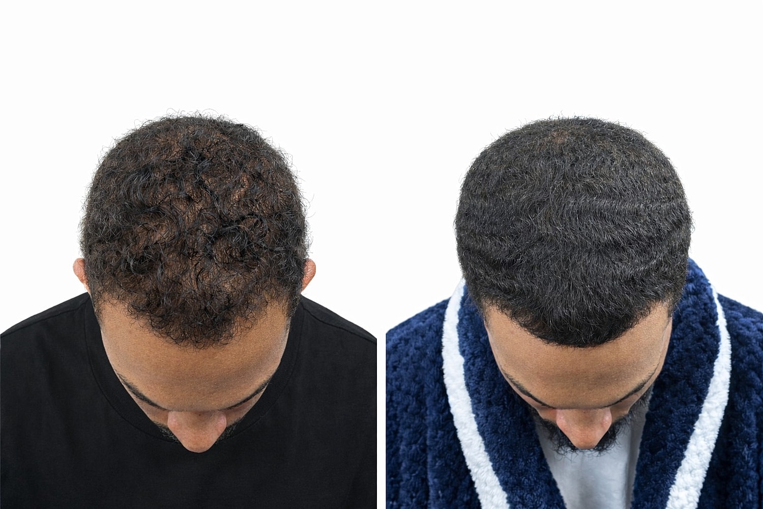 PRP Hair Restoration Before & After