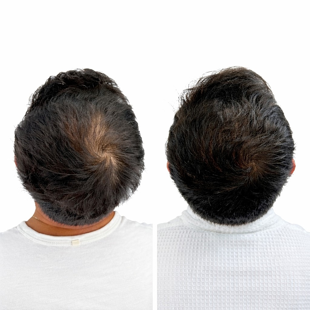 PRP Hair Restoration Before & After