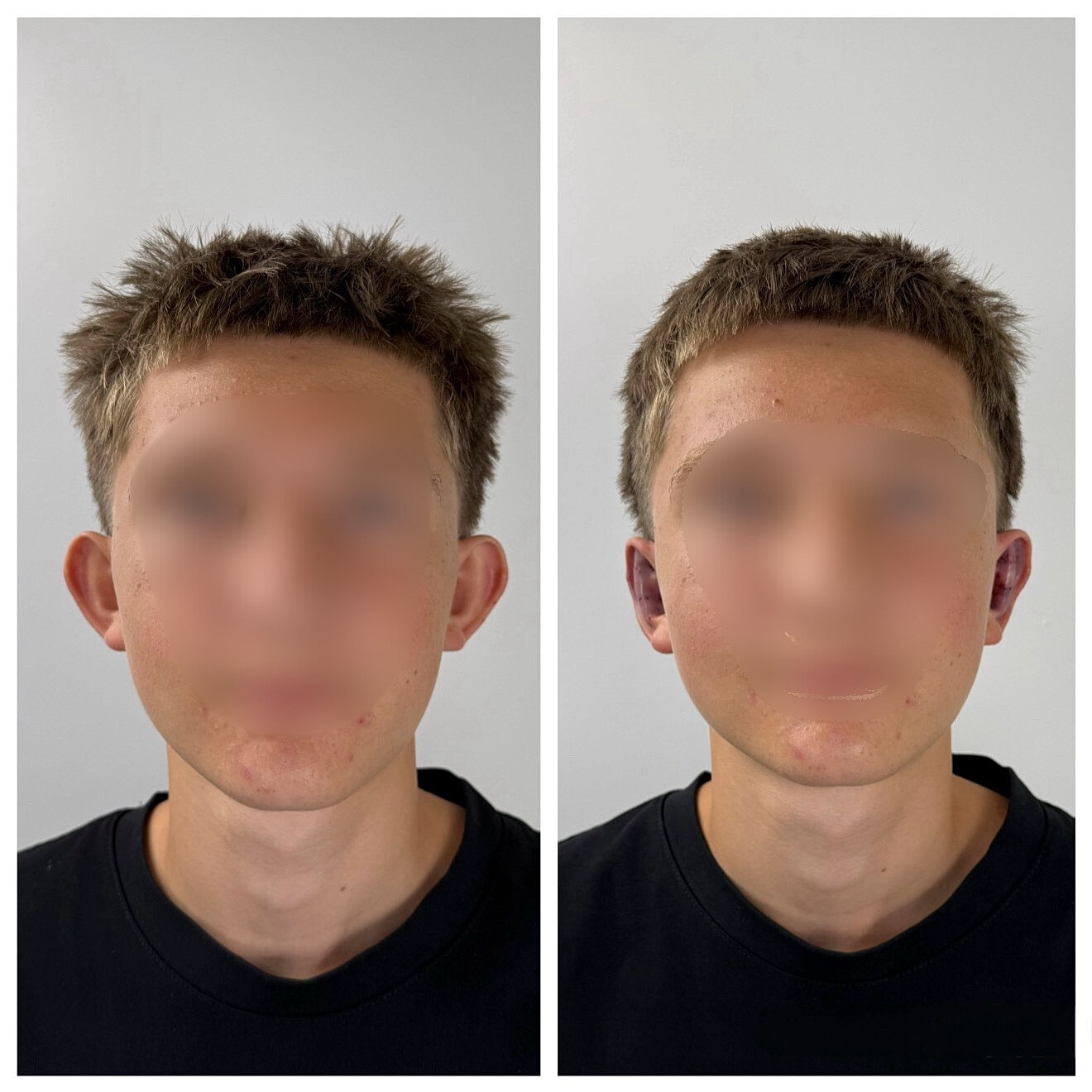 Ear Reshaping Before & After