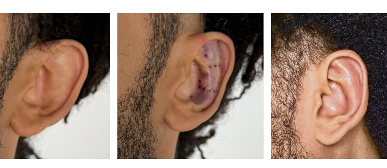 Ear Reshaping Before & After