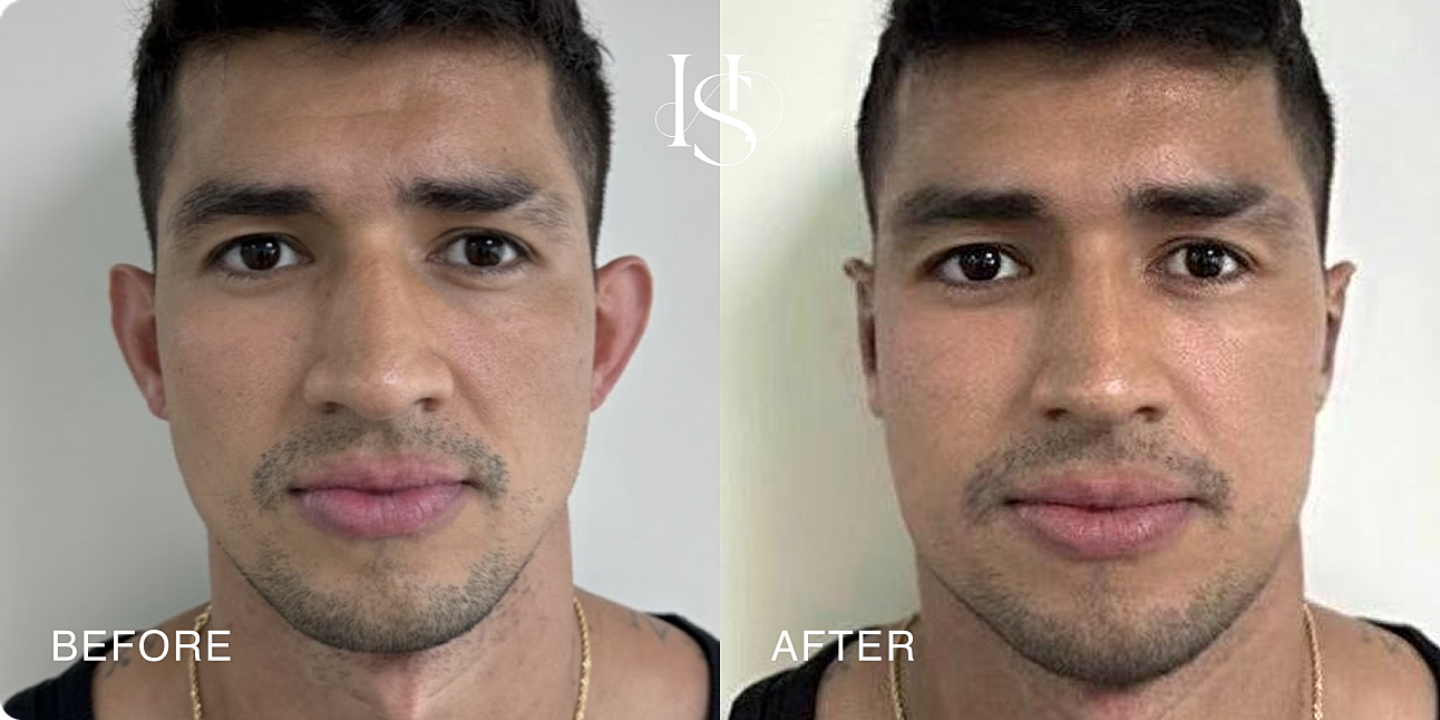 Transformation before and after facial treatment.