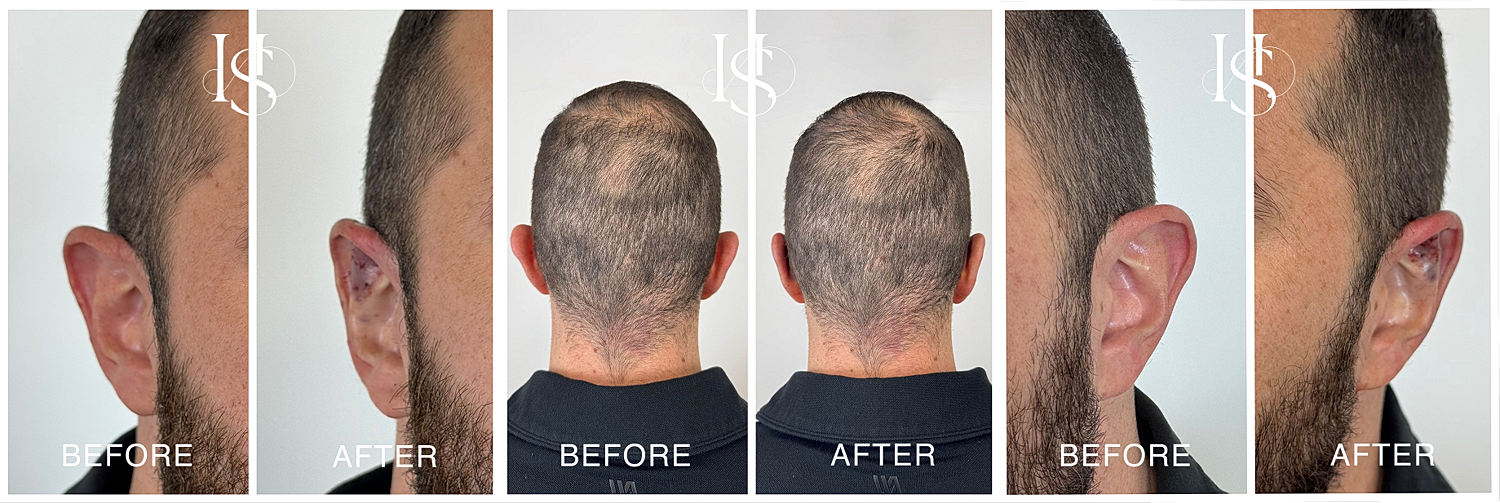 Hair restoration results before and after treatment.