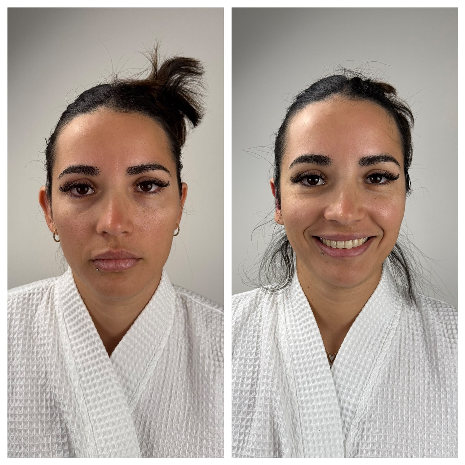 Ear Reshaping Before & After