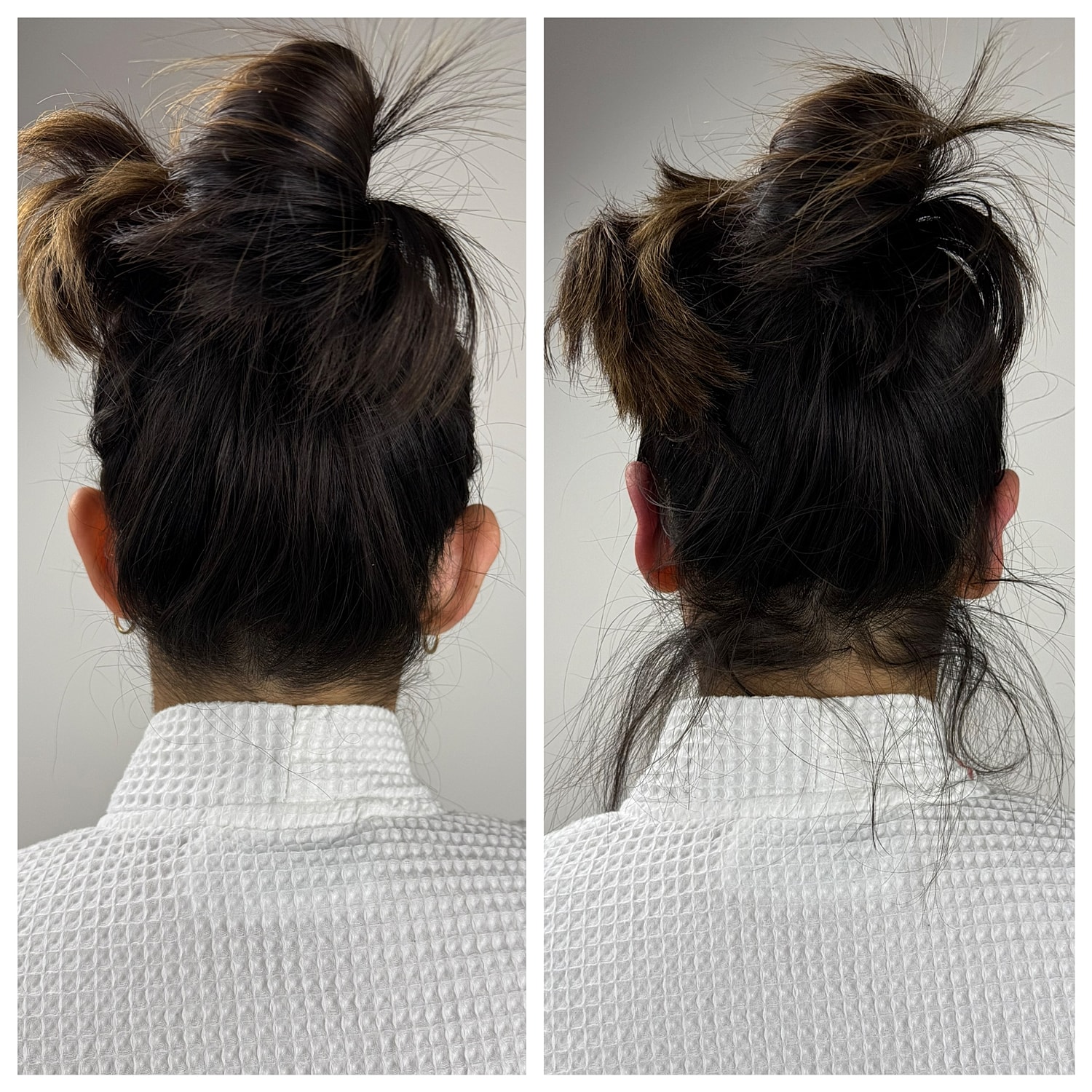 Ear Reshaping Before & After