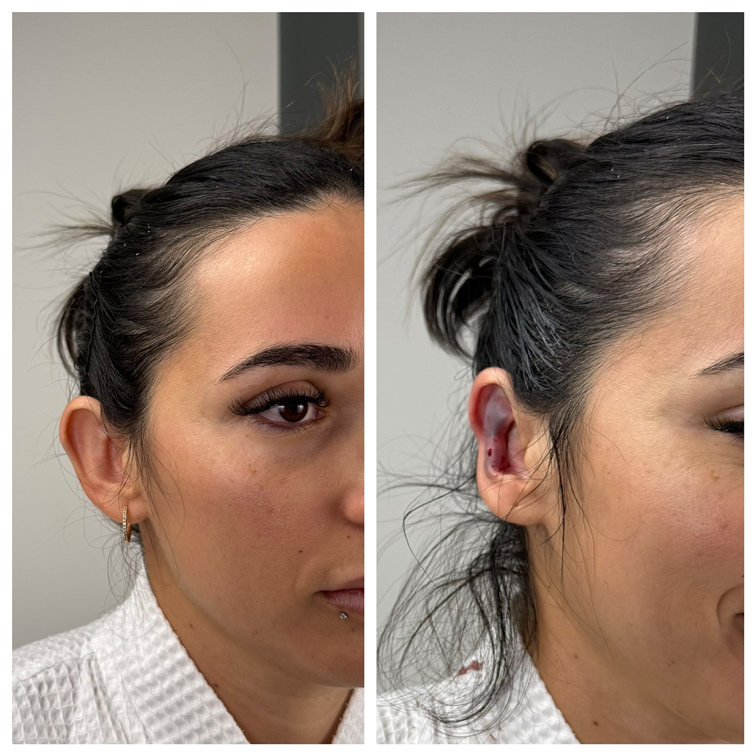 Ear Reshaping Before & After