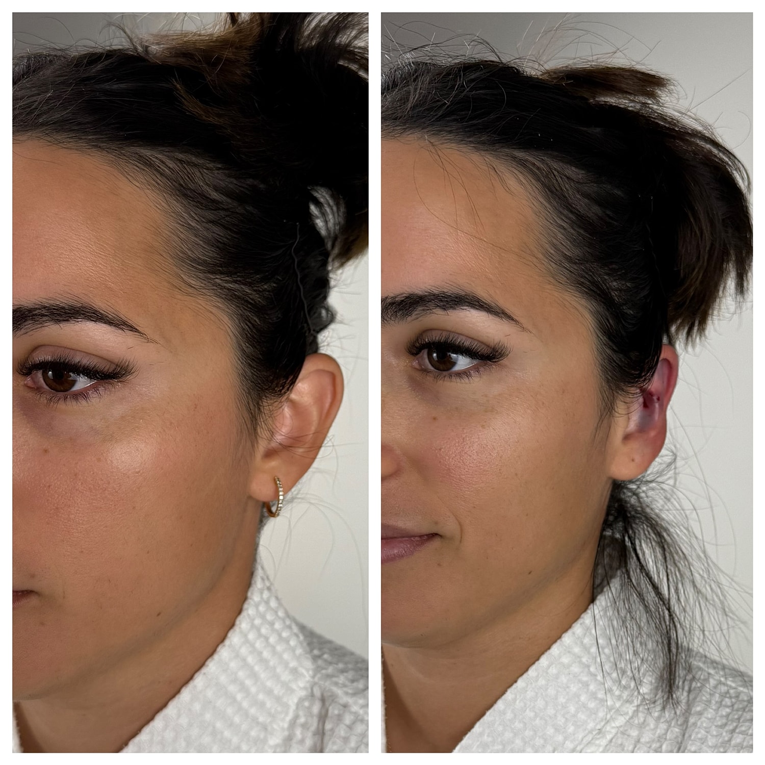 Ear Reshaping Before & After