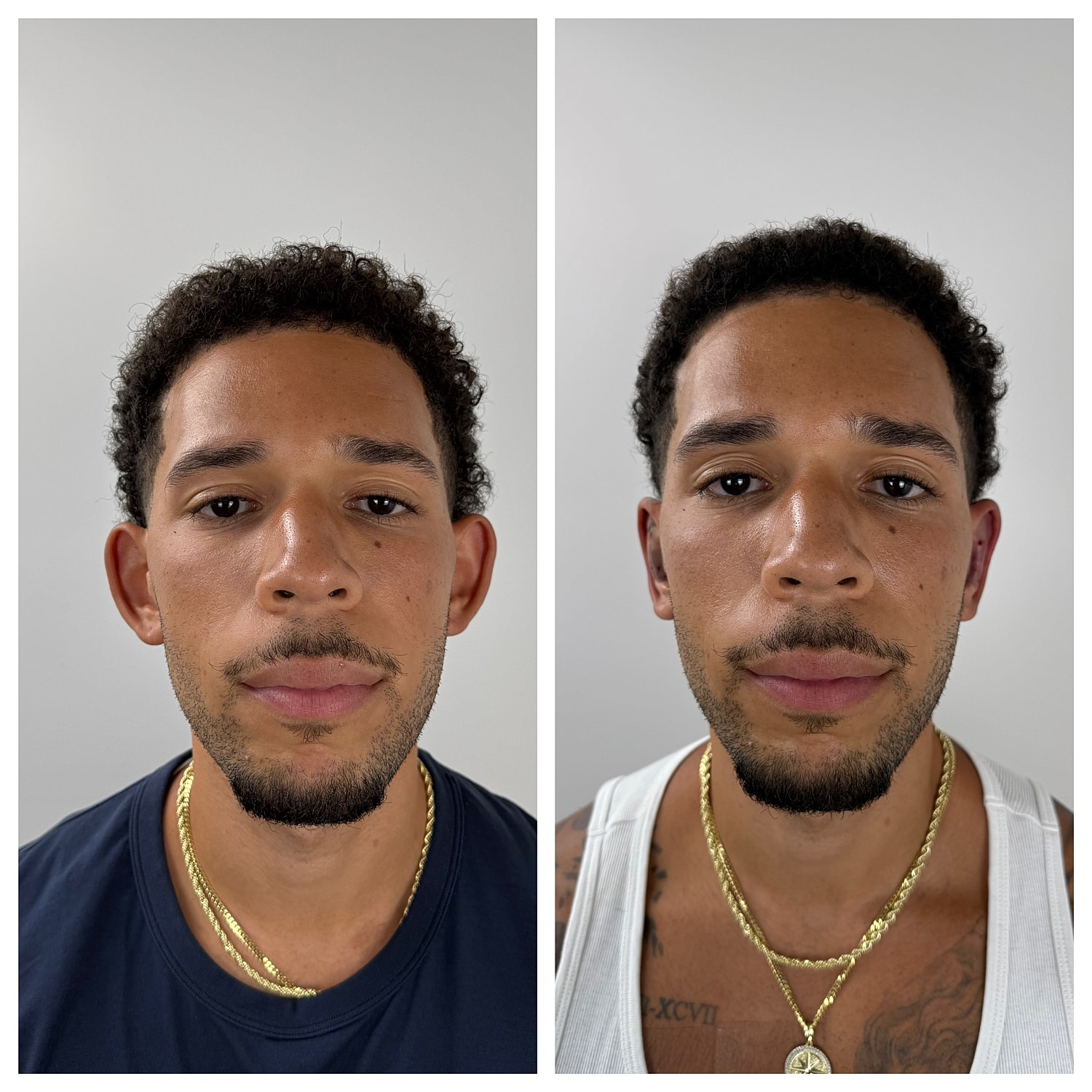 Ear Reshaping Before & After