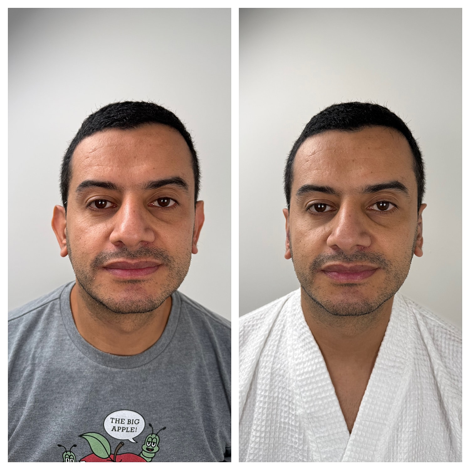 Ear Reshaping Before & After